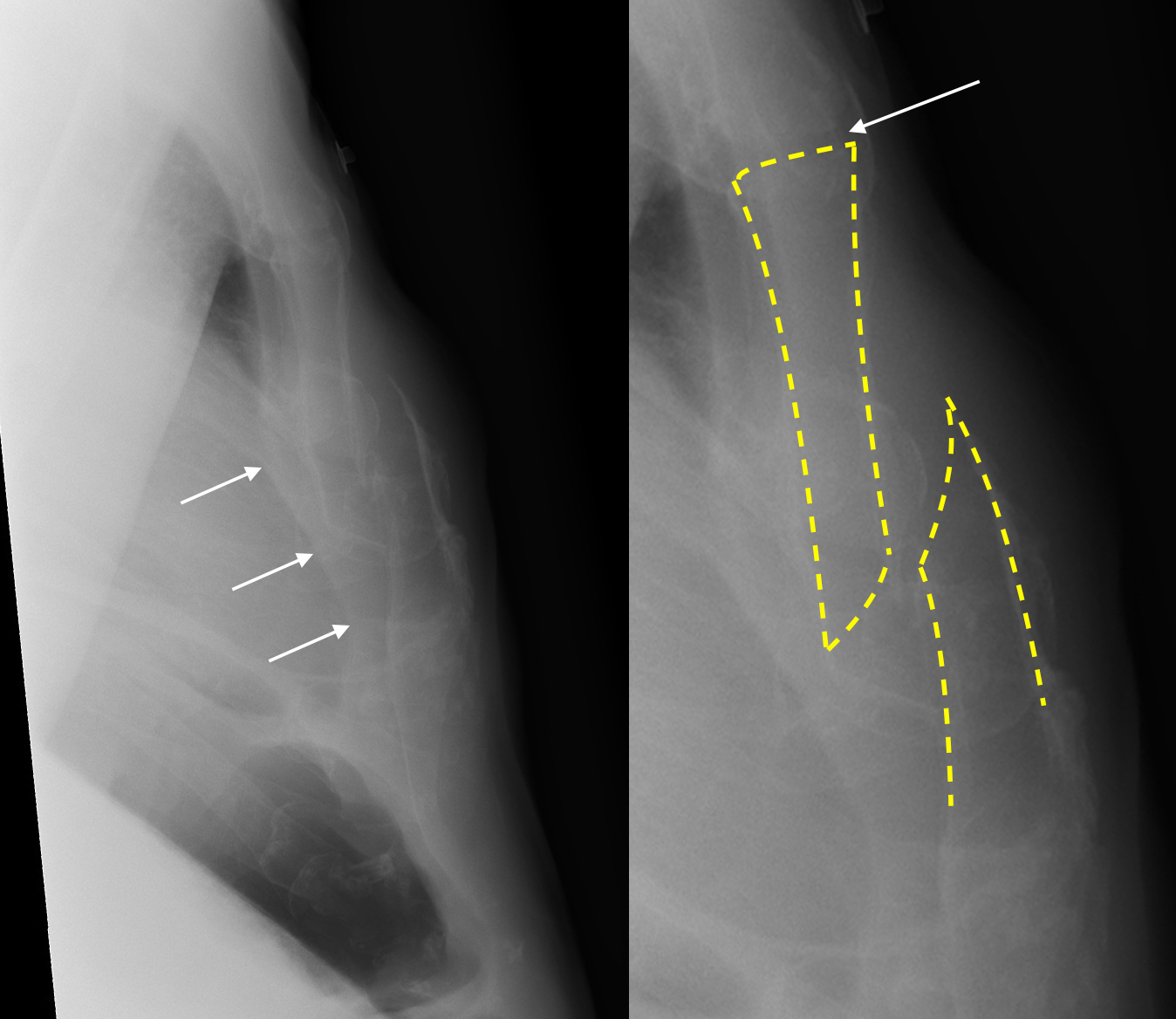 What is the xray for a sternum fracture?