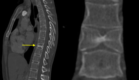 Butterfly vertebra