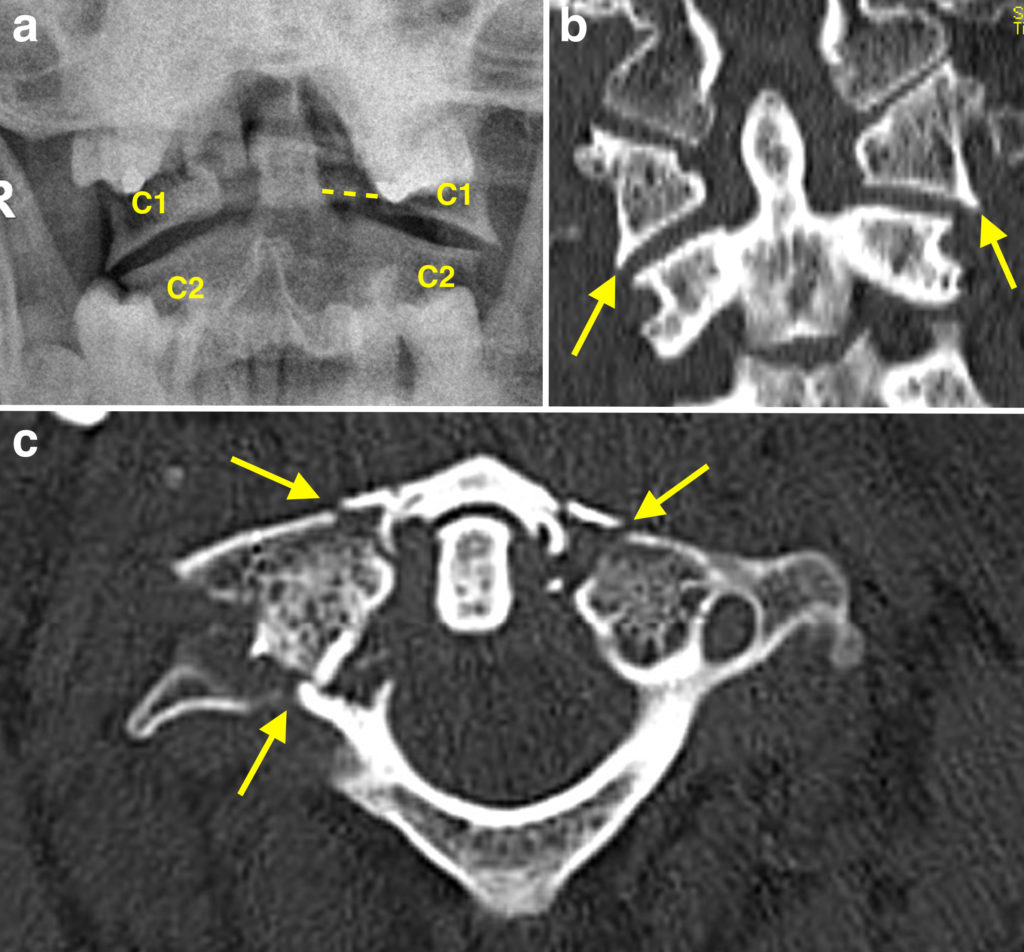 Odontoid and hangman fracture