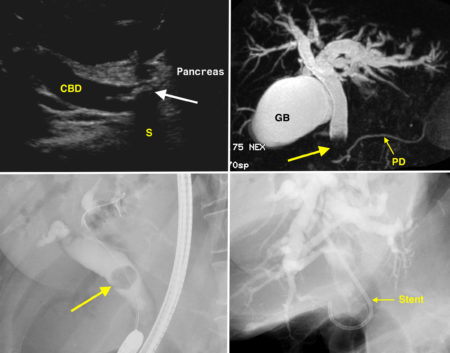 Common duct calculus – multimodality imaging