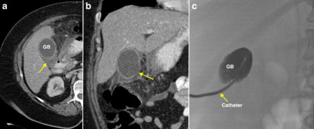 Percutaneous cholecystostomy