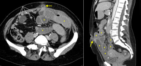 Small bowel obstruction due to port site hernia – CT