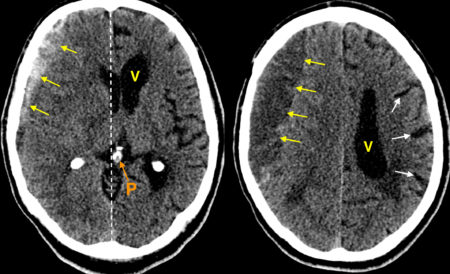 Acute on chronic subdural haematoma