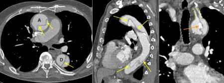 Thoracic aortic dissection – CT