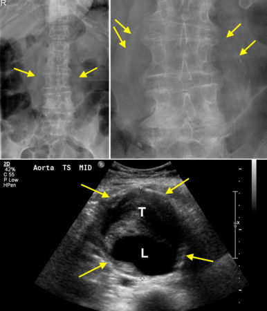 Calcified abdominal aortic aneurysm – lumbar spine radiograph