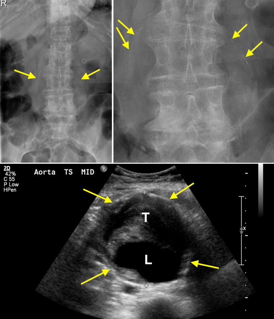 Calcified Abdominal Aortic Aneurysm Lumbar Spine Radiograph
