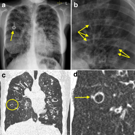 Bronchiectasis – CXR and CT