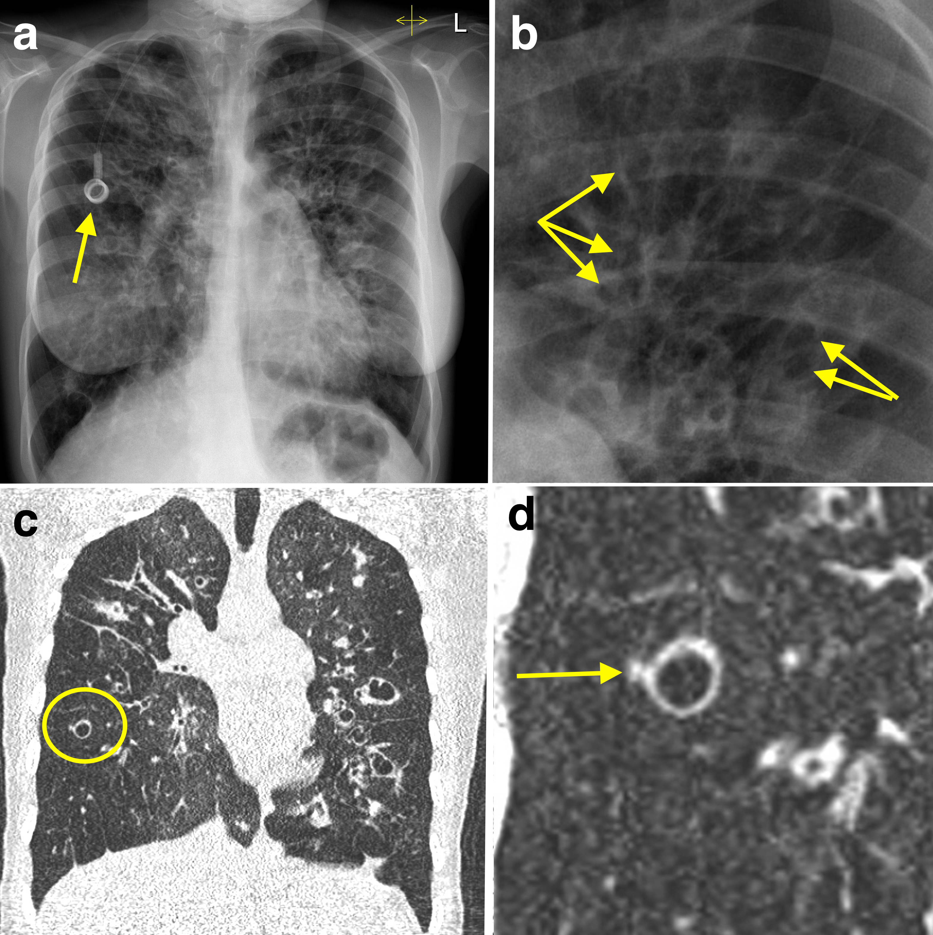 Bronchiectasis - CXR and CT - Radiology at St. Vincent's University