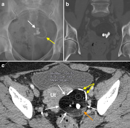 Ovarian dermoid cyst