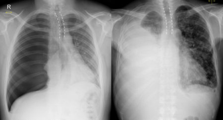 Tracheal shift on CXR