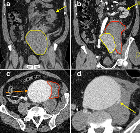 Ruptured aneurysm mimicking renal colic