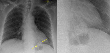 ‘Double heart sign’ – CXR