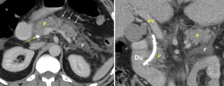 Acute pancreatitis post-ERCP