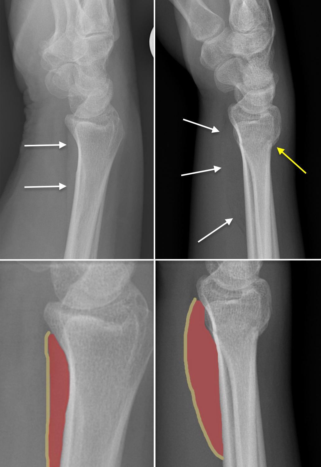 Pronator quadratus fat pad sign - Radiology at St. Vincent's University