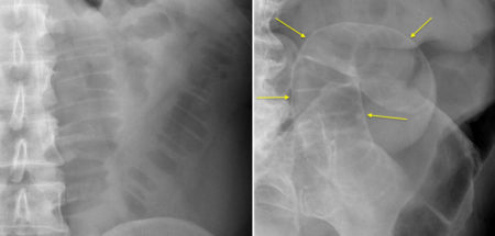 Rigler’s sign in small bowel obstruction