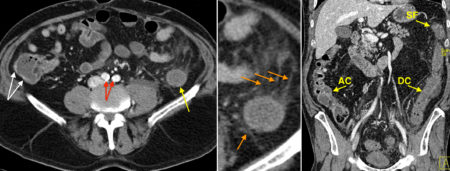 Ischaemic colitis – CT