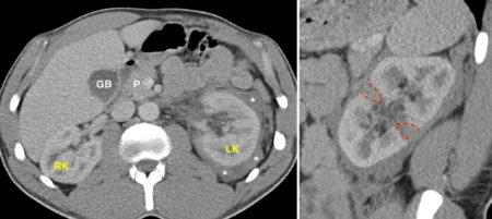 Renal laceration – CT