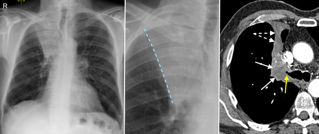 Right Upper Lobe Collapse Cxr Ct Radiology At St Vincents