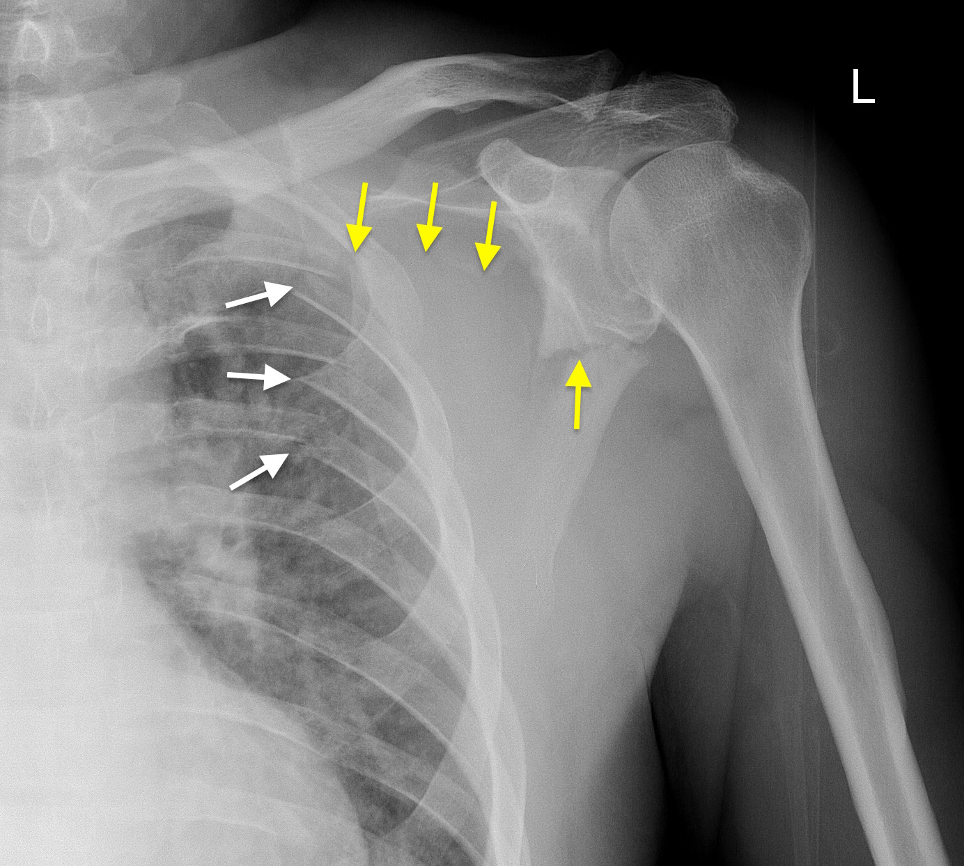 Scapular fracture - Radiology at St. Vincent's University Hospital