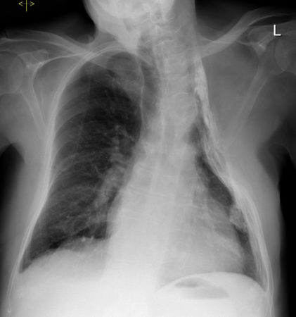 Thoracoplasty – chest radiograph