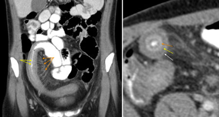 Comb sign and target sign – Crohn disease