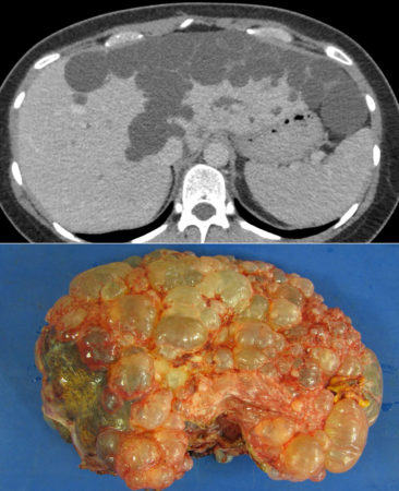 Polycystic liver disease