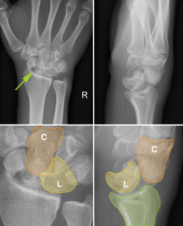 Perilunate dislocation