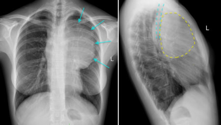 Anterior mediastinal mass - Radiology at St. Vincent's University Hospital