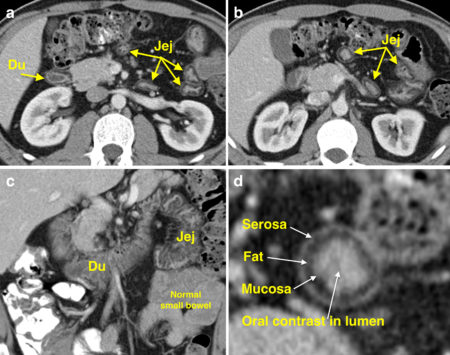 Coeliac disease – CT