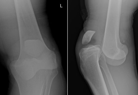 Anterior knee dislocation