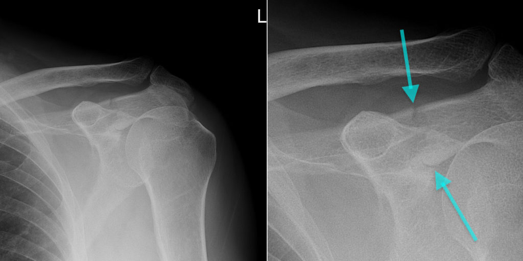 Acromion Fracture - Radiology at St. Vincent's University Hospital