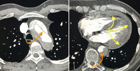 Aortic dissection with haemopericardium