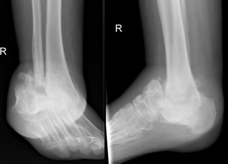 Neuropathic joint – Charcot-Marie-Tooth disease