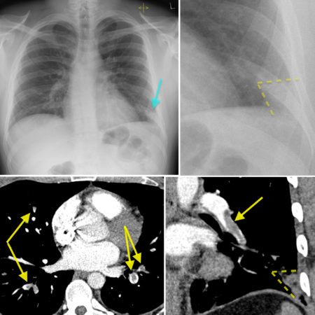 Hampton’s Hump – pulmonary embolism