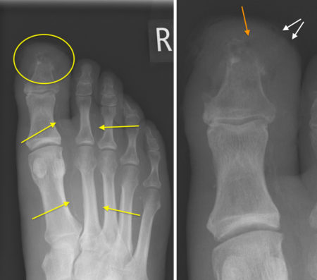 Diabetic foot – osteomyelitis