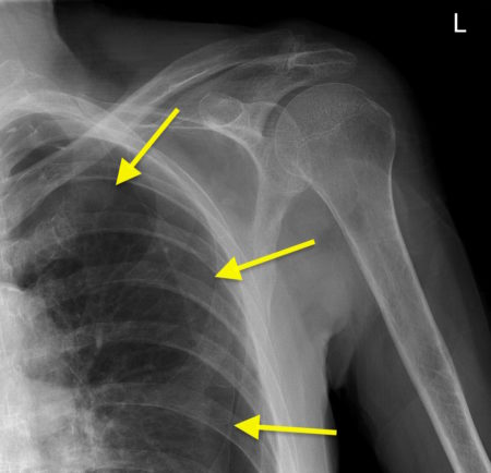 Pneumothorax on shoulder X-ray
