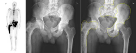 Polyostotic Paget’s disease