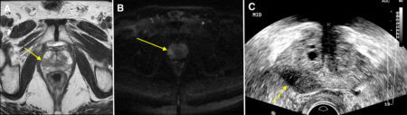 Prostate cancer – MRI