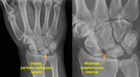 Kienbock’s disease