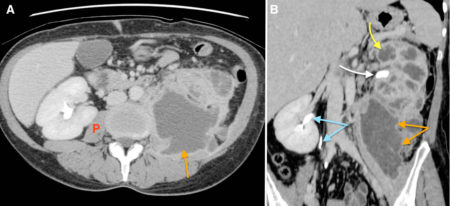 Xanthogranulomatous pyelonephritis (XGP)