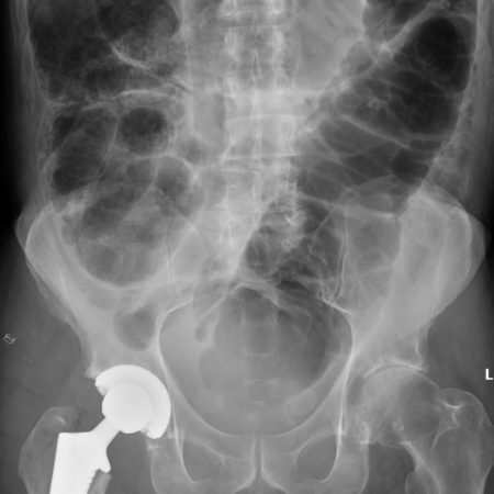 Colonic pseudo-obstruction