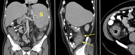 Typhlitis