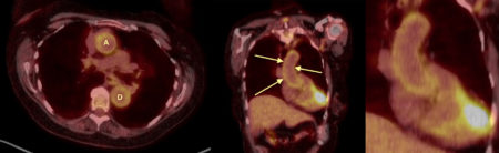 Giant cell arteritis