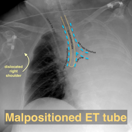 Malpositioned endotracheal tube