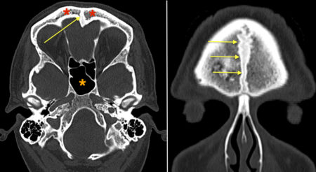 Persistent metopic suture