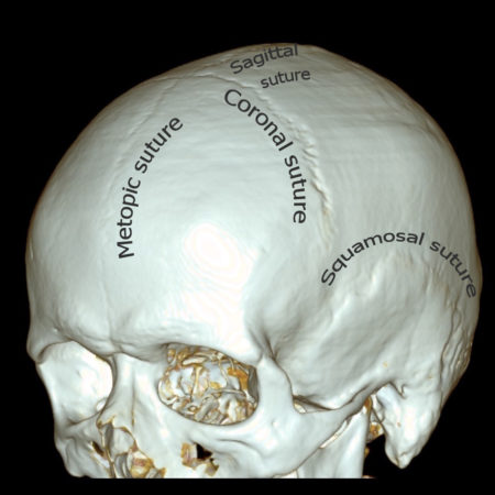 suture metopic persistent radiology