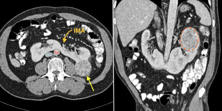 Horseshoe kidney with RCC - Radiology at St. Vincent's University Hospital