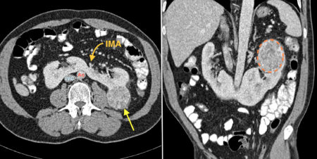 Horseshoe kidney with RCC