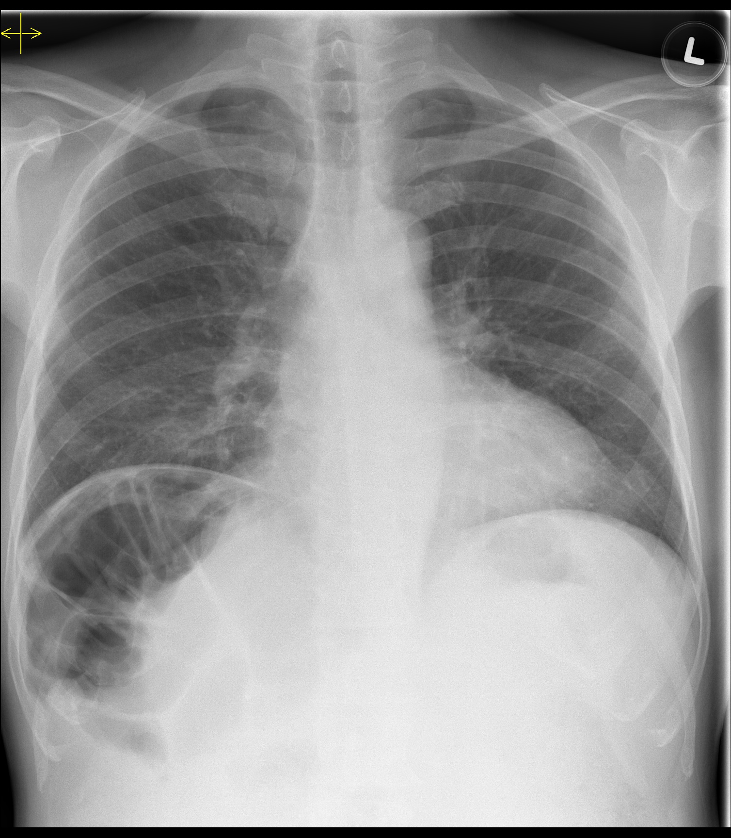 Chilaiditi's sign (colonic interposition) - Radiology at St. Vincent's